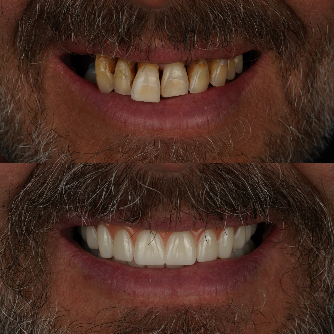 Before and after dental implants with crowns and bridges